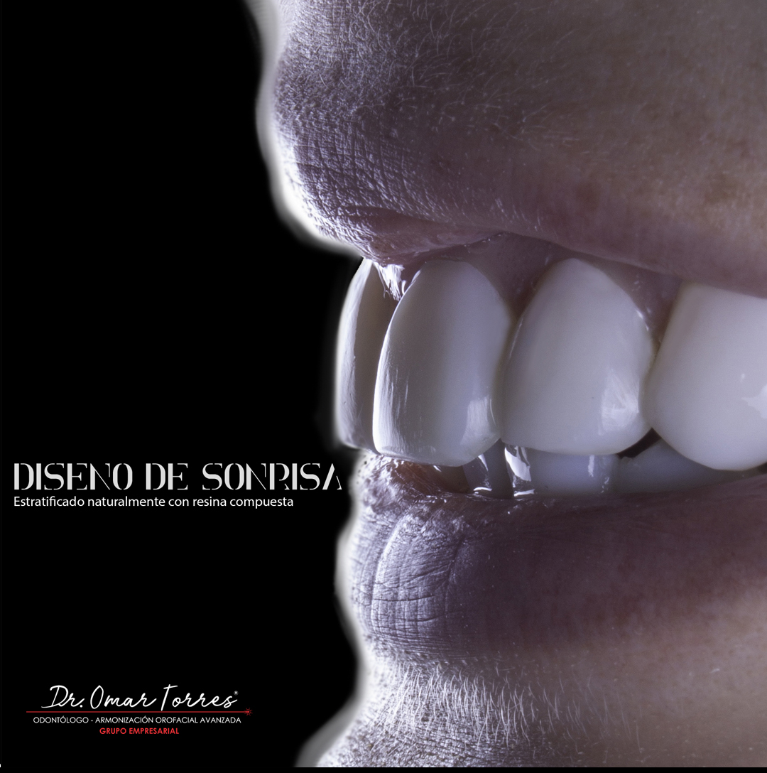 Cambia tu vida y sonríe sin miedos. 
¡No te pierdas la experiencia Dr. Omar torres ®️! 😀👍
¡SIN DESGASTAR TUS DIENTES! 

#dromartorres #cambiandovidas #odontologialaser #armonizacionfacial #bichectomialaser #reducciondepapada 🌟🌟 #elodontologodelosfamosos