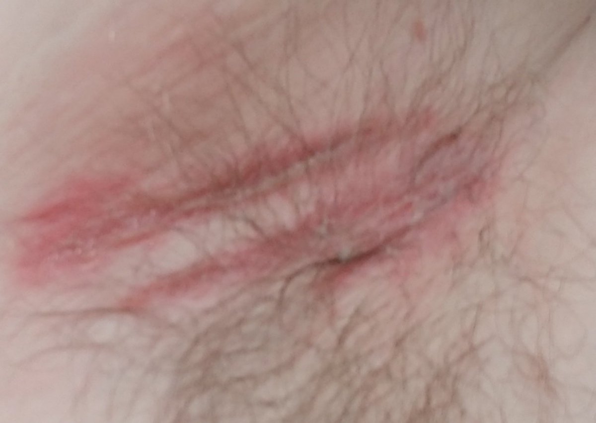 RevRunLineD's tweet photo. Hey @OldSpice I appreciate your $6 offer to help relieve the 2nd degree chemical burn I received by the use of your product. Is this the great customer service touted by your PR talent? #smellegendary #runoldspice #oldspice #oldspicedad https://t.co/Yl9OOvjU55