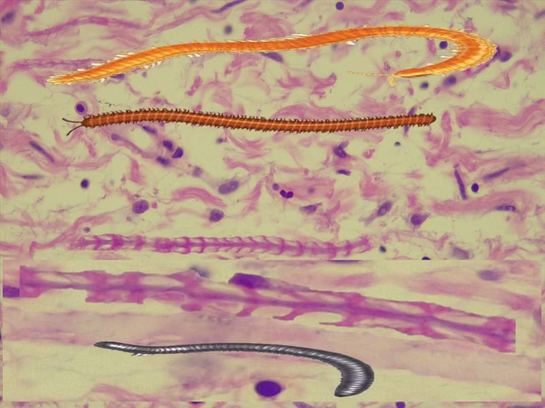 josemiguelcruza's tweet photo. Neurofibroma / Cisura Schmidt-Lanterman / Ciempiés. 
#pathArt #pathology #PathTwitter #dermpathjc. #ASDPTweets. https://t.co/apvYNP6OZM