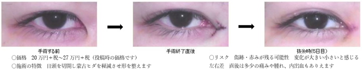 目頭の世界 در توییتر 蒙古ヒダの形を整えていくのがのが目頭切開 初期経過のお写真を見てみます ヒダを軽減 今回のケースだと強いヒダをほぼなくす しているのがわかりますね 目頭切開 目頭 蒙古ひだ