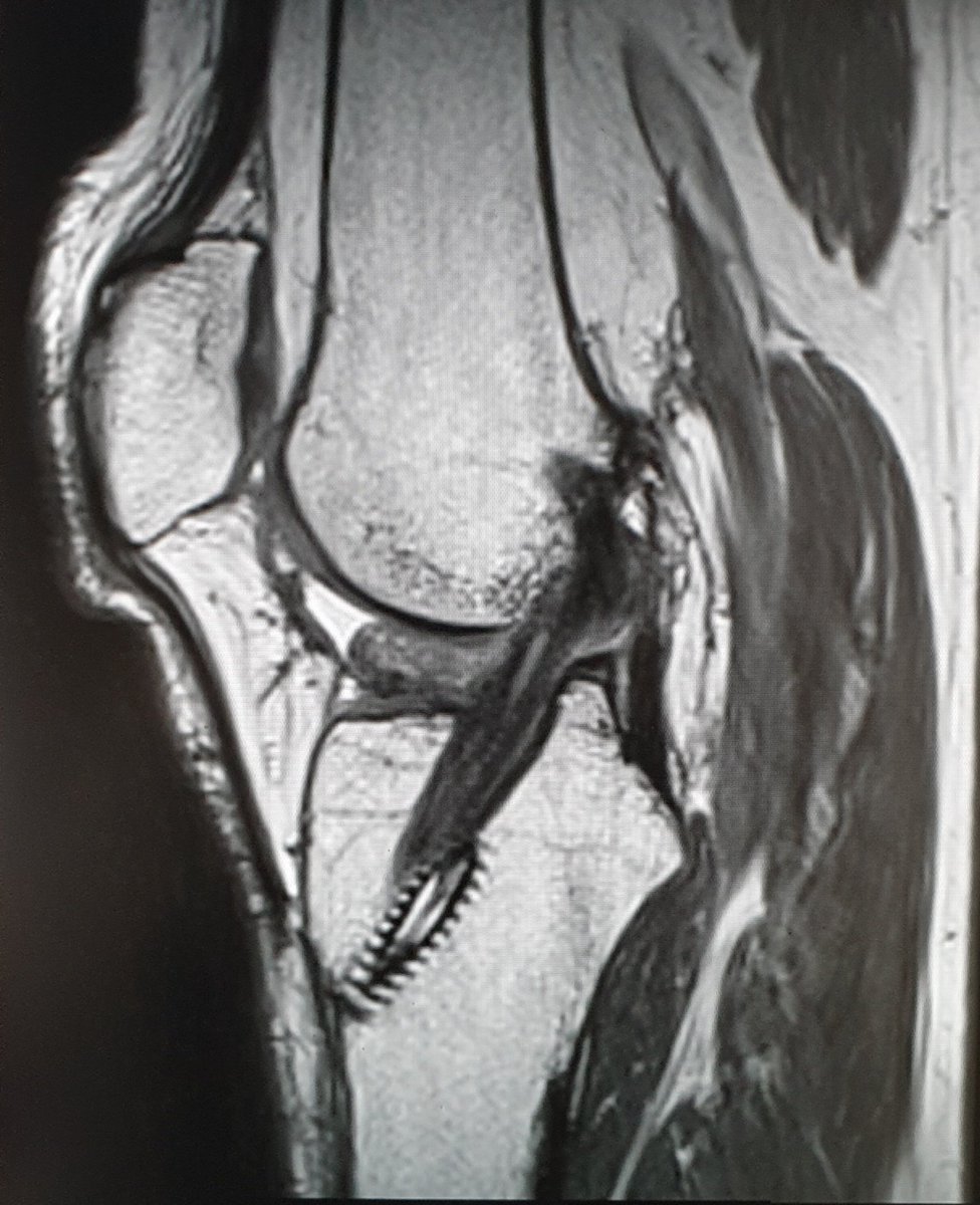 mskradiologist's tweet photo. For those who ain't quite sure whether to call a 'Cyclops lesion',  pre-and post images (pd space) 👁️. Excellent work from @SotonKneeClinic 
#mskrad #FOAMrad https://t.co/MY6mfFR8YX