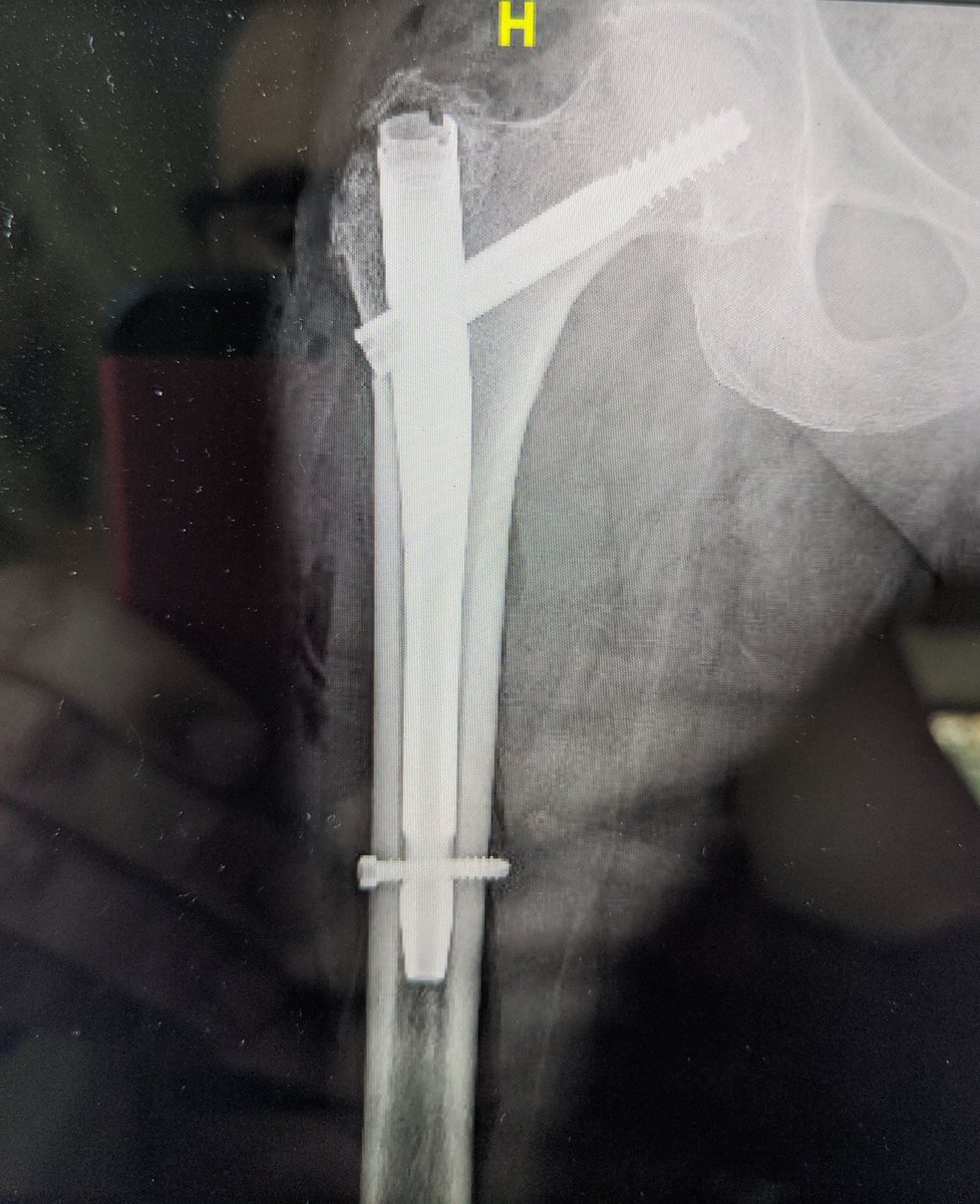 DeFrodaSportsMD's tweet photo. We do bread and butter too. 92 yo fall. Short nail at the community hospital. Shorter OR time, less steps, less blood loss and easier on weekend staff. No difference in outcome compared to long nail. @BrownOrthoSurg @chrismcd90 #shawty #hipfracture #RTP #WBAT #weekendvibes #call https://t.co/u8TxdOEYVC