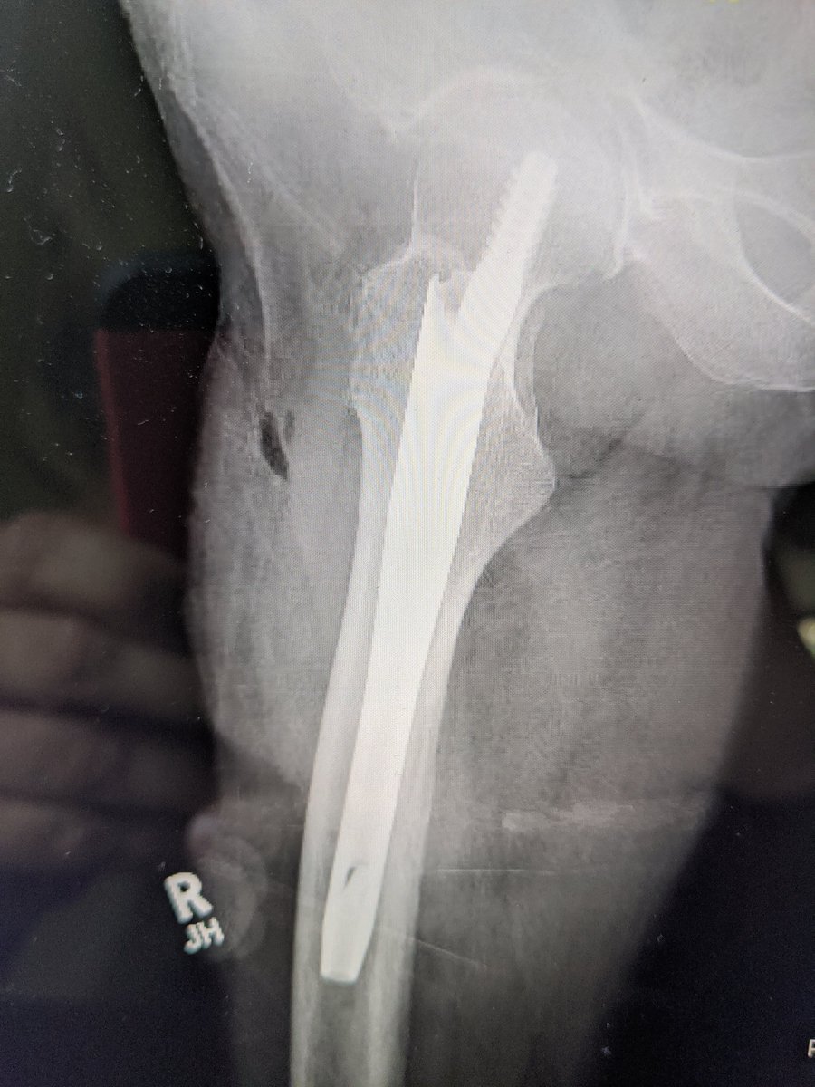 DeFrodaSportsMD's tweet photo. We do bread and butter too. 92 yo fall. Short nail at the community hospital. Shorter OR time, less steps, less blood loss and easier on weekend staff. No difference in outcome compared to long nail. @BrownOrthoSurg @chrismcd90 #shawty #hipfracture #RTP #WBAT #weekendvibes #call https://t.co/u8TxdOEYVC
