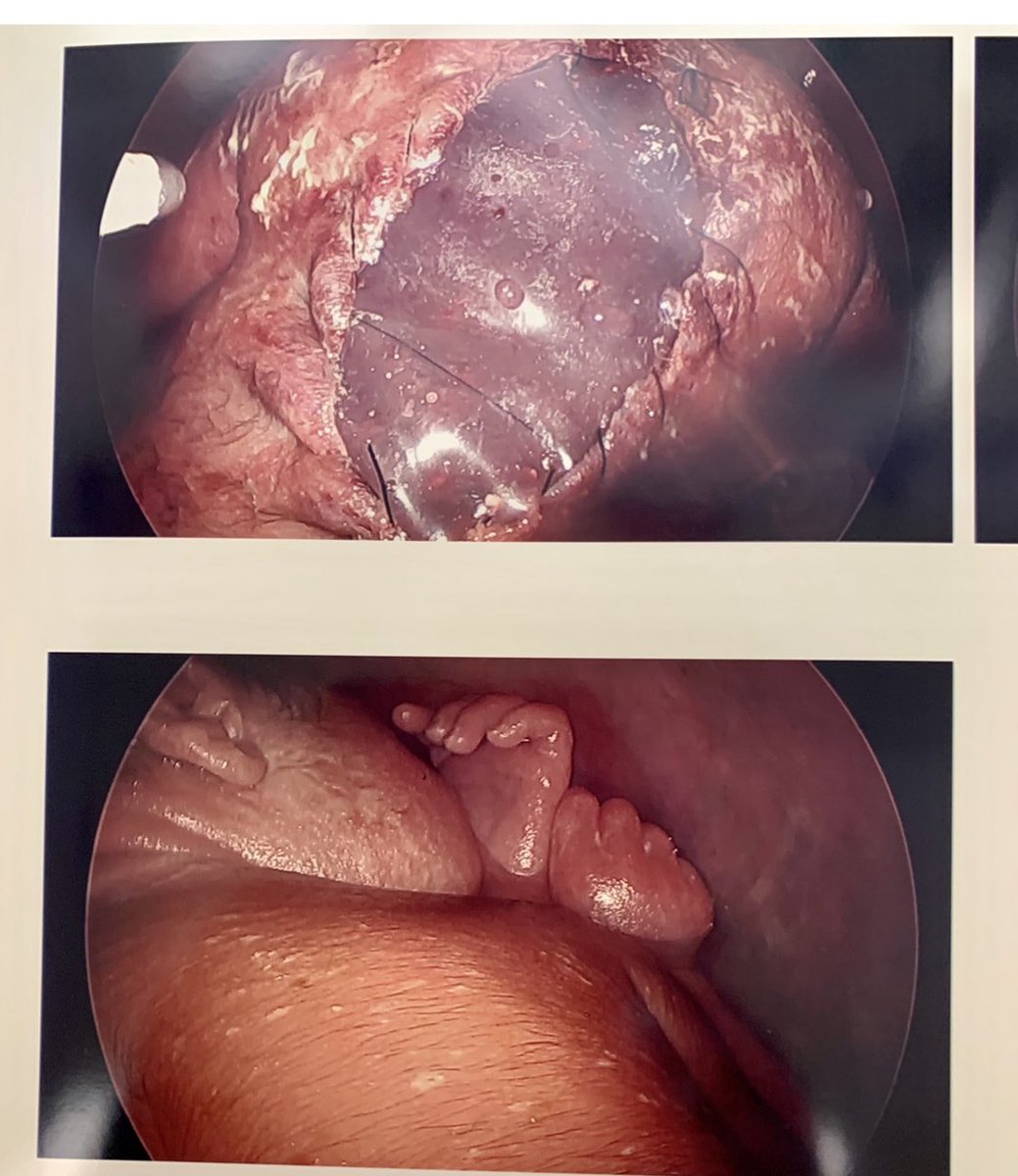Fetoscopic spina bifida repair in 3 layers. The skin defect was large, so a skin substitute was used for coverage. #spinabifida *shown with permission
