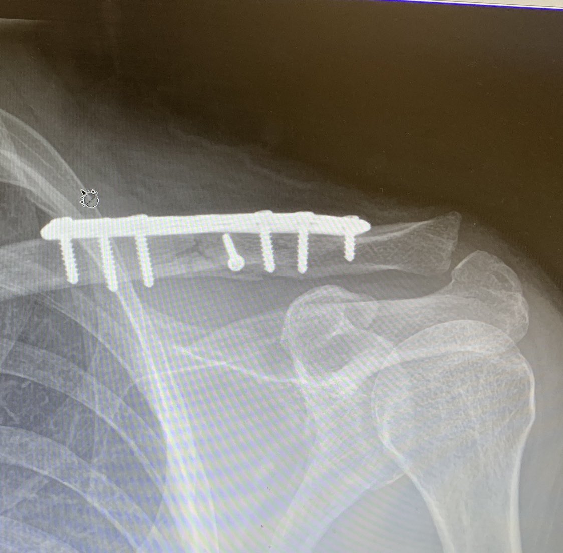 Restarted easy swimming today, six weeks after a bike accident and collarbone ORIF surgery.  Thanks to the great staff at <a href="/BeaconOrtho/">Beacon Orthopaedics</a> I’m back training for Ironman Louisville coming up in 119 days #podiumorbust