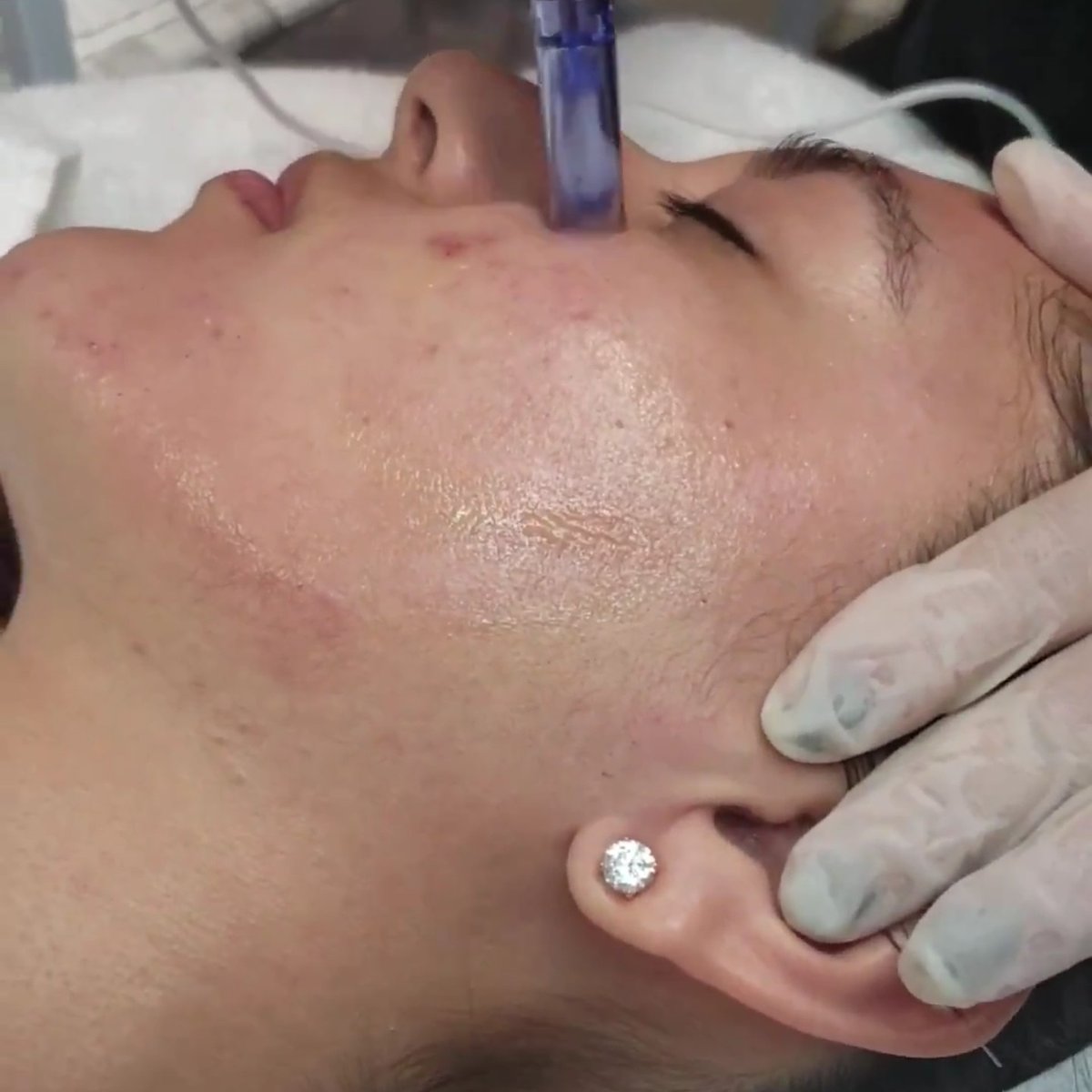 facialsbyceci's tweet photo. Microneedling with PRP
Introductory price for $220
Call for an appointment
or book online.
#YouWillLoveIt
#BetterCollagen
#VampireFacial
#ComeToSeeMe https://t.co/wmBSAMMjEp