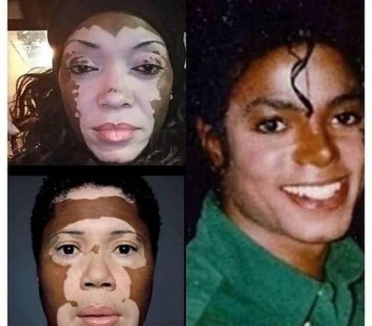 Understanding Michael Jackson's Skin Transformation Exploring the