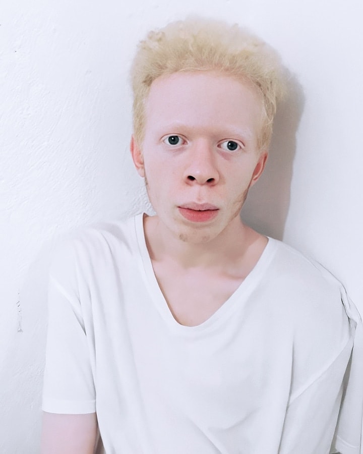 MattheuxxsD's tweet photo. 13 de junho Dia Internacional de Conscientização do Albinismo
#inmyskiniwin #albinism #albinismisbeautifl https://t.co/Oq0GcMIetf