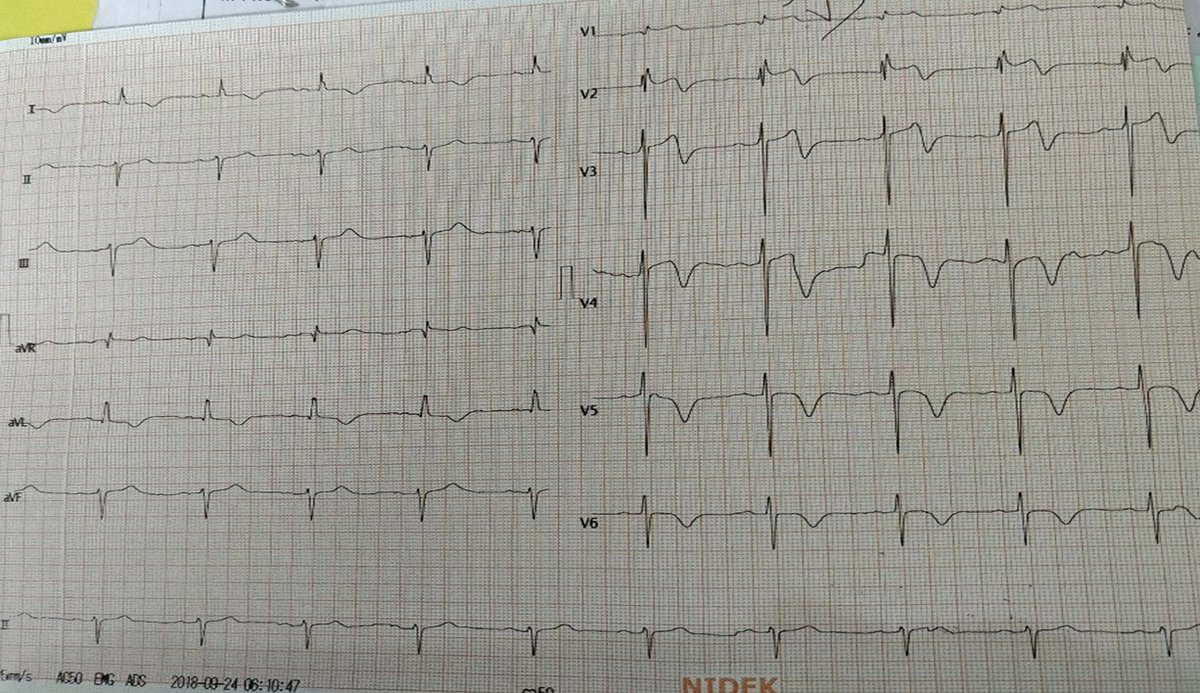 81 Y doctor-chest pain and breathlessness x 3 hours. ECG  shows tombstone pattern  ST elevation in V1-V6 &amp; AVR suggestive of Ostial LAD Occlusion. Post thrombolysis ECG shows STE resolution and T wave inversion in V1-V3 s/o recanalised LAD.  #ecg #veluecgblog