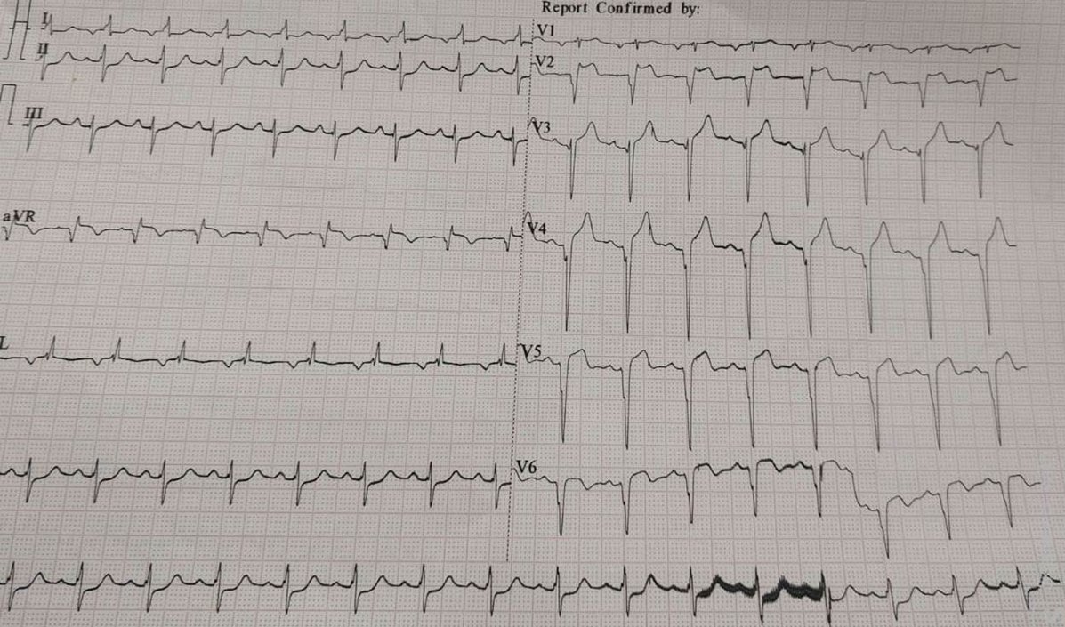 60/M chest pain.ECG-qRBBB STE V1-V5 s/o ostial LAD occlusion seen in angiogram. Post PCI to ostial LAD  disappearance of qRBBB s/o successful recanalisation. qRBBB-grave prognosis, large myocardium at risk, more LVSD, mechanical &amp; electrical complications. #veluecgblog #ECG