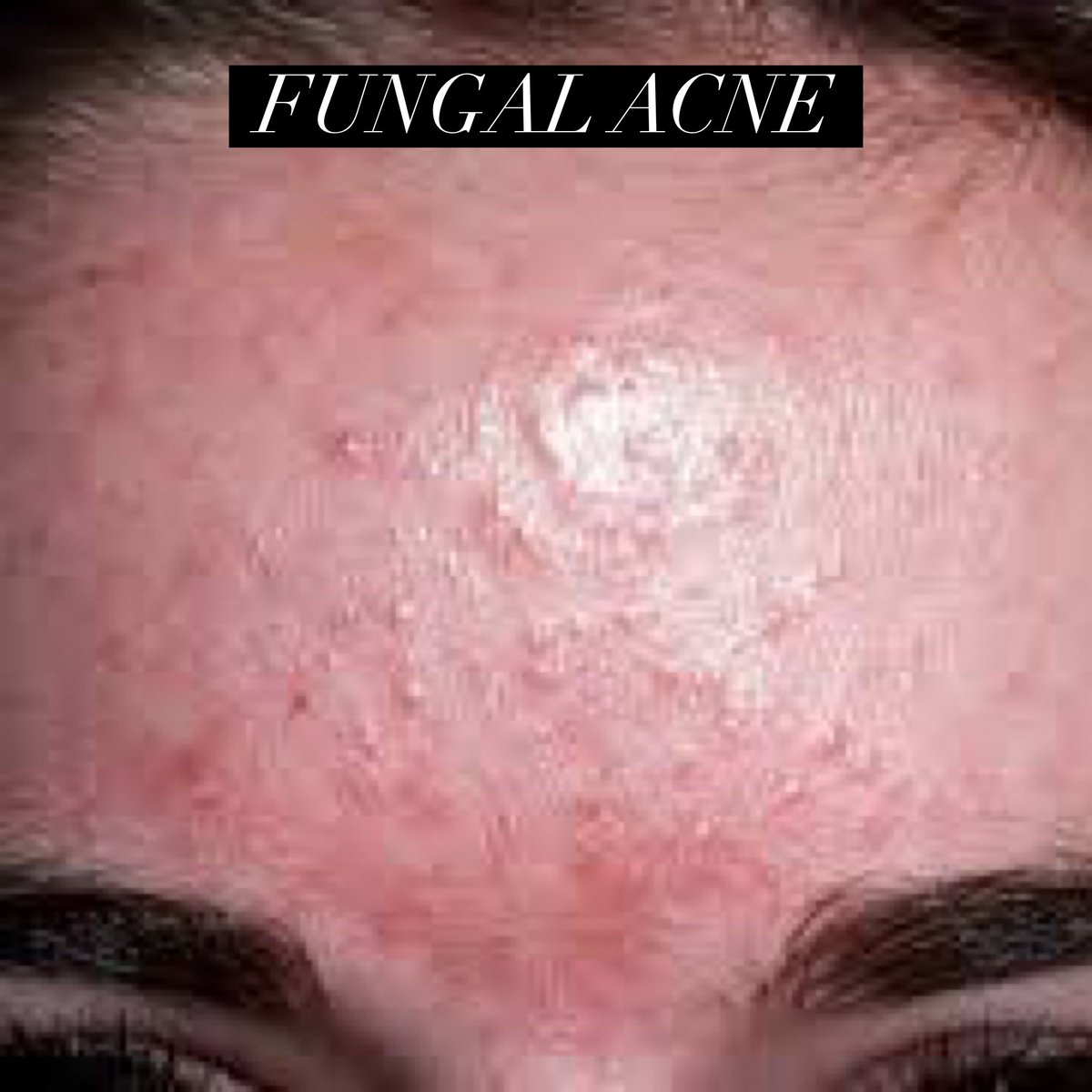 Fungal Acne On Body