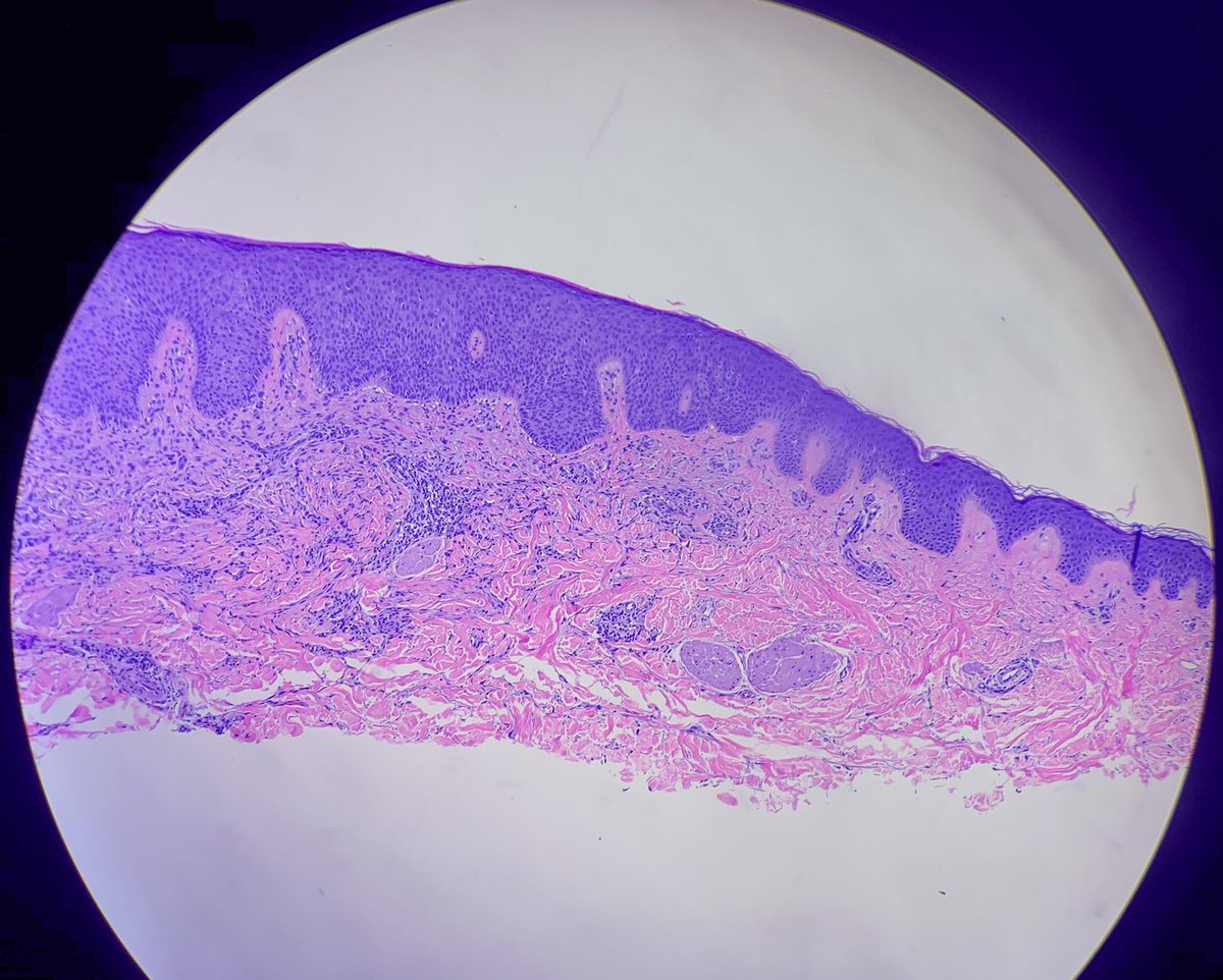 HENRYY_MD's tweet photo. another interesting case concerning โlymphoid aggregates โ in spindle lesions. 35 yo man arm lesion. #Dermpath #pathology #challengecases @MarcelaSaebL @forthejon @VKazlouskaya @Dr_Jukic @et565 @david_terrano @DrGeeONE @TheDrJNY https://t.co/Vzm6dv16YF