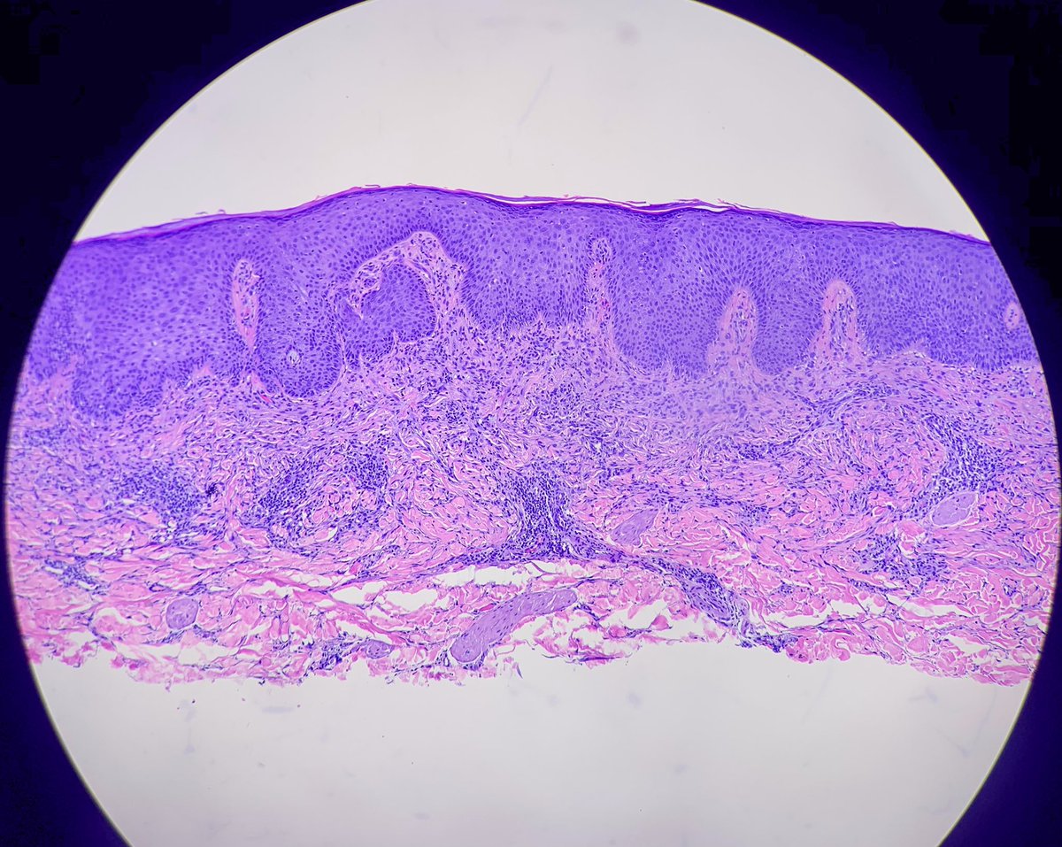 HENRYY_MD's tweet photo. another interesting case concerning โlymphoid aggregates โ in spindle lesions. 35 yo man arm lesion. #Dermpath #pathology #challengecases @MarcelaSaebL @forthejon @VKazlouskaya @Dr_Jukic @et565 @david_terrano @DrGeeONE @TheDrJNY https://t.co/Vzm6dv16YF