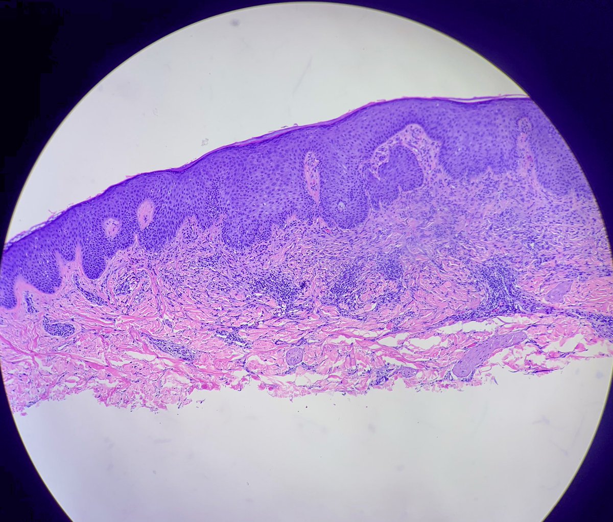 HENRYY_MD's tweet photo. another interesting case concerning โlymphoid aggregates โ in spindle lesions. 35 yo man arm lesion. #Dermpath #pathology #challengecases @MarcelaSaebL @forthejon @VKazlouskaya @Dr_Jukic @et565 @david_terrano @DrGeeONE @TheDrJNY https://t.co/Vzm6dv16YF