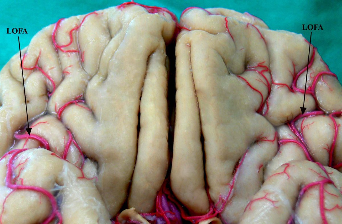 DrBaskaya's tweet photo. Lateral orbitofrontal arteries (#LOFA), supply of lateral part of #orbitofrontal cortex, gave rise to many small branches, course in the sulci of orbitofrontal cortex but did not make anastomosis with medial orbitofrontal arteries.
https://t.co/dyDlDGWMPV
#nsgy #neuroanatomy https://t.co/BoFgLNhuJR