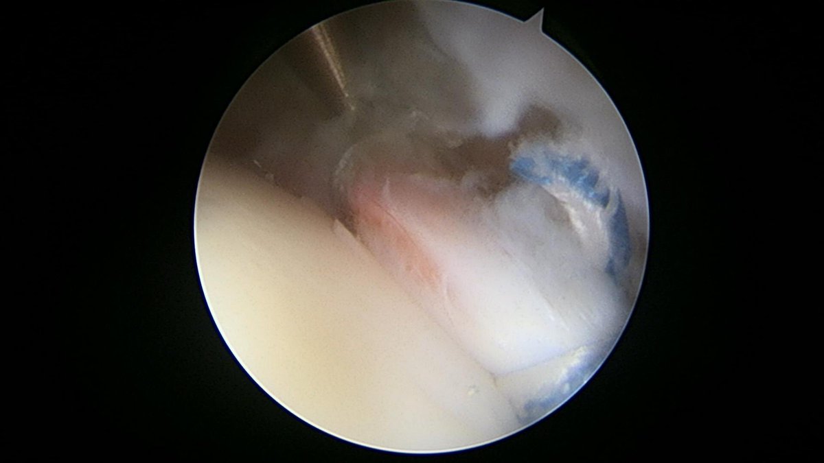 CzarneckiMD's tweet photo. Over 90% of hip labral tears involve impingement. In this case combined acetabular pincer and femoral cam impingement caused the issue #hipimpingement #hiplabralrepair https://t.co/kUFDuhmhjK