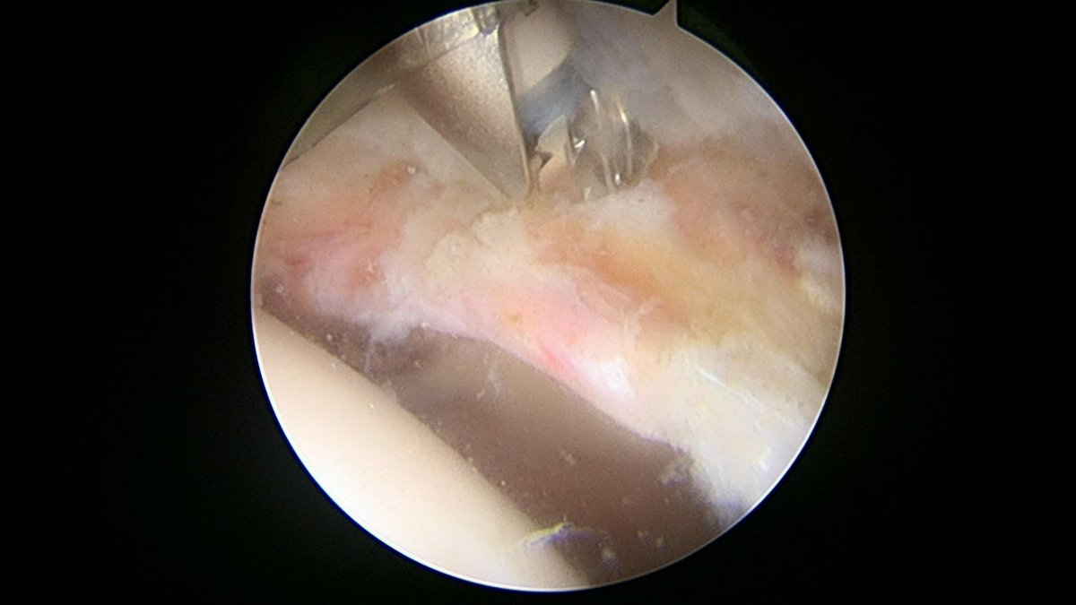 CzarneckiMD's tweet photo. Over 90% of hip labral tears involve impingement. In this case combined acetabular pincer and femoral cam impingement caused the issue #hipimpingement #hiplabralrepair https://t.co/kUFDuhmhjK