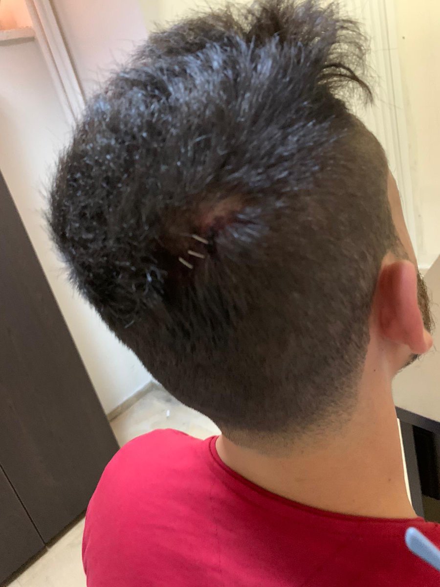 MSTanrikulu's tweet photo. Diyarbakır Çarşı Karakolu'nun karşısında cafe işleten iki esnaf kardeş dün Çarşı Karakolu'nda bu hale getirilmiş
3 diş yok, kafada dikişler ve çok sayıda darp izi. 
Polis her zamanki gibi mukavemet tutanağı tutmuş. 
Yapılanlar çok açık işkence suçudur
@TC_icisleri @DBakirValiligi https://t.co/iWL7HC3e8g