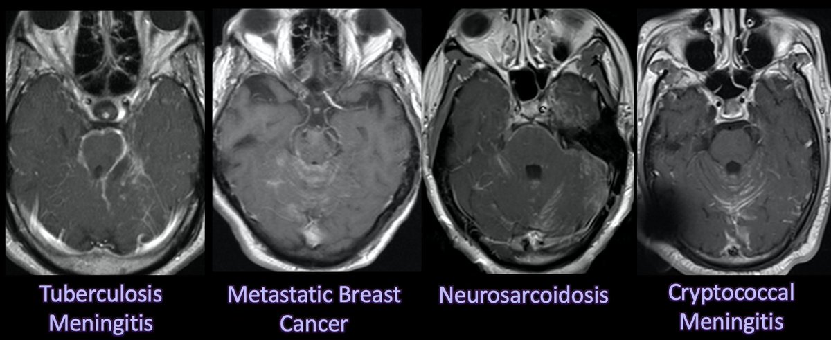 Leptomeningeal Enhancement

4 different cases of basilar predominant leptomeningeal enhancement, all look very similar!

1. Tuberculosis meningitis
2. Metastatic breast cancer 
3. Neurosarcoidosis
4. Cryptococcal meningitis

#neurorad #radres #meded #foamrad #neurology