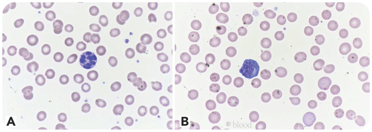 Hypersegmented granulocytes and COVID-19 infection ow.ly/tMJC50A6nxb #COVID19