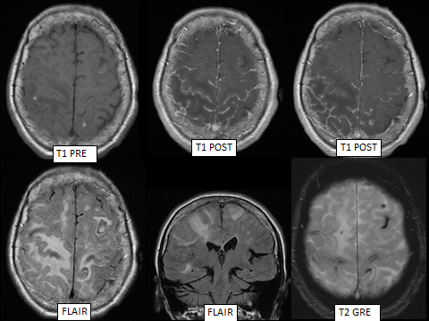 Hammerdongle's tweet photo. Dick's Pick of the Week: Inflammatory-Cerebral Amyloid Angiopathy

Findings: Multifocal leptomeningeal enhancement, lobar vasogenic edema, and peripheral cerebral microbleeds and superficial siderosis. 

#FOAMed #FOAMrad #radres #NeuroRad #radiology #Neurology https://t.co/OTx1t2QF5F