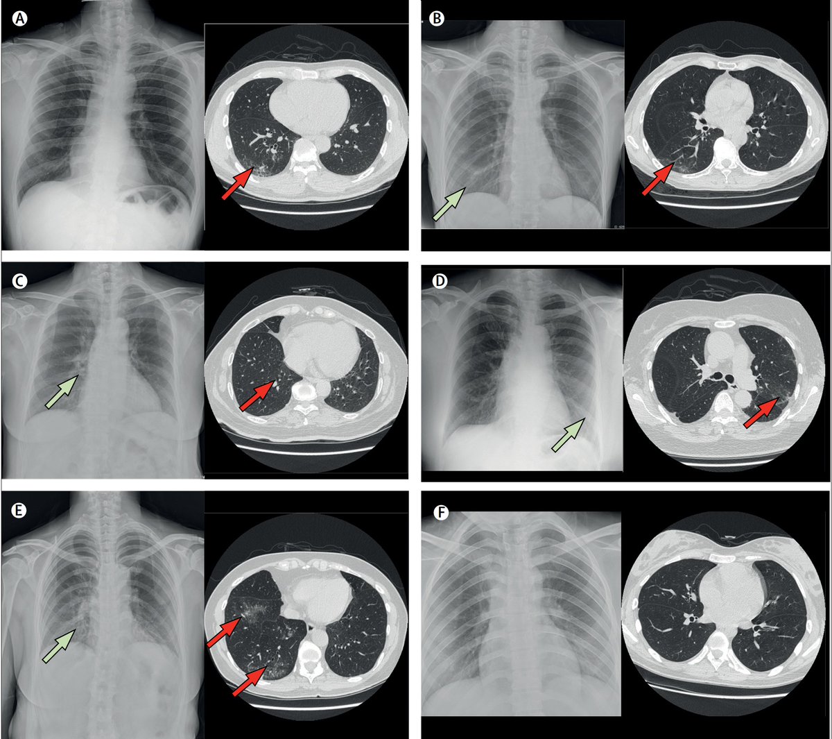 4. There are now 3 series of lung CT scans in people who were asymptomatic....