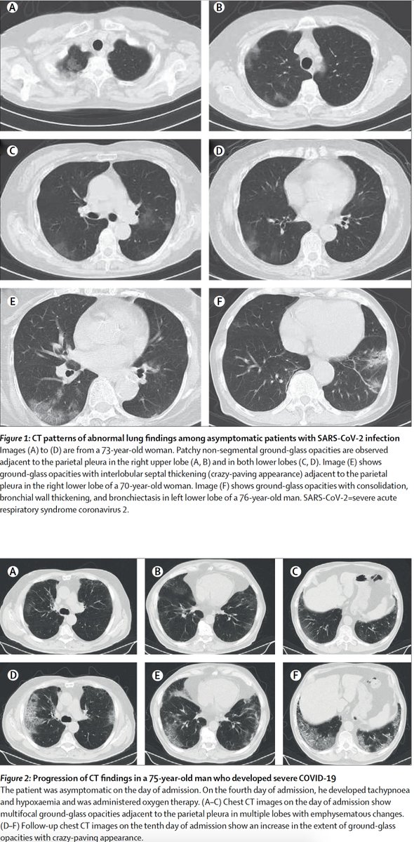 4. There are now 3 series of lung CT scans in people who were asymptomatic. More than half of these patients show distinct GGO abnormalities consistent w/  #COVID19 https://www.thelancet.com/journals/laninf/article/PIIS1473-3099(20)30364-9/fulltext https://www.thelancet.com/journals/laninf/article/PIIS1473-3099(20)30482-5/fulltext https://www.medrxiv.org/content/10.1101/2020.05.09.20096370v1.full.pdf