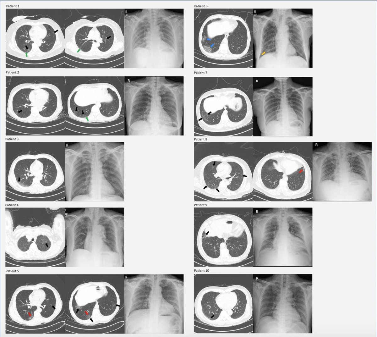 4. There are now 3 series of lung CT scans in people who were asymptomatic. More than half of these patients show distinct GGO abnormalities consistent w/  #COVID19 https://www.thelancet.com/journals/laninf/article/PIIS1473-3099(20)30364-9/fulltext https://www.thelancet.com/journals/laninf/article/PIIS1473-3099(20)30482-5/fulltext https://www.medrxiv.org/content/10.1101/2020.05.09.20096370v1.full.pdf