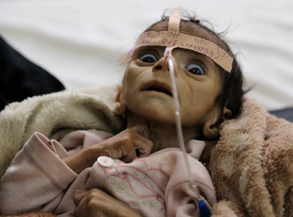 jaafeeeerrrrr's tweet photo. what's happening in YEMEN is not humane, yemen is on the verge of going extinct and everyone’s silent! 
A child dies every 10 minutes because of STARVATION, DISEASE and AIR STRIKES.. 
Don’t stay silent, you have the privilege to help stop it and raise awareness.
#YemenCrisis https://t.co/uXJjDXFmDP