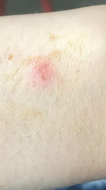 uce25ar's tweet photo. @fitbit @FitbitSupport 
This is what Fitbit Versa did... it literally burnt .. please watch and avoid using fitbit watches.. these are low quality and isnt safe.
And in response fitbit saying they will pay for Ointment if any user ... cheap company, cheap products...
#avoidfitbit https://t.co/8LKAugpkpP