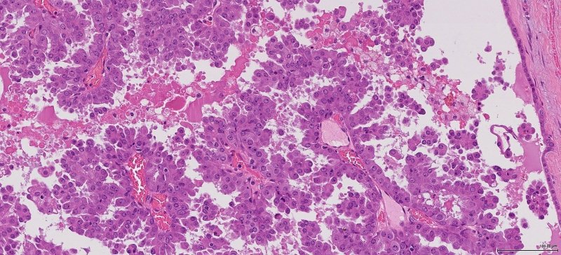 Acinic cell carcinoma
turkaramamotoru.com/en/acinic-cell…
#Aciniccellcarcinoma