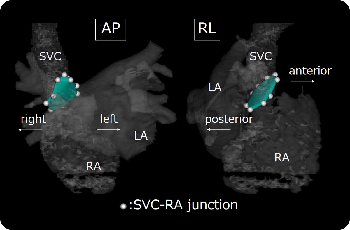 Visualization of the electrophysiologically defined junction between the superior vena cava and right atrium onlinelibrary.wiley.com/doi/abs/10.111… 
Just a simple message, SVC-RA junction is slanting. The anterior side is higher.