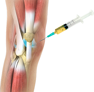 ProfDavidHunter's tweet photo. Curious how this consensus statement on PRP injections in knee #osteoarthritis contrasts with systematic reviews citing trial quality concerns and guideline recommendations that are more neutral in their recommendation https://t.co/fxOykRtjeL https://t.co/5KepeCKgp8