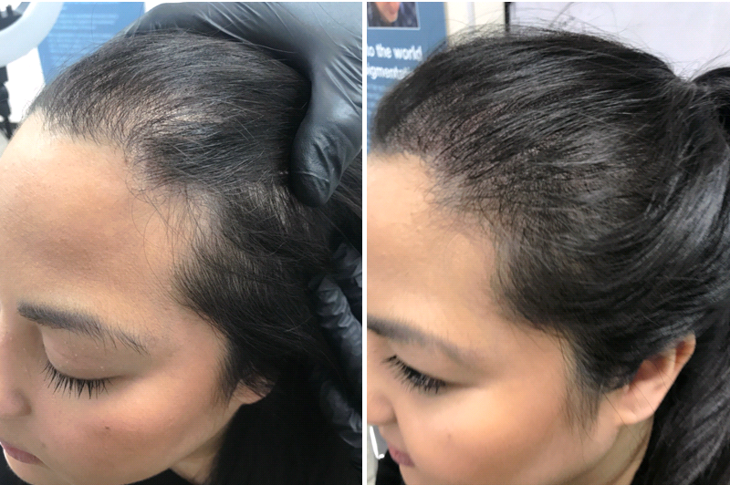 Transform your hairline with the popular, non-invasive scalp #micropigmentation treatment. It's suitable for both men and women!