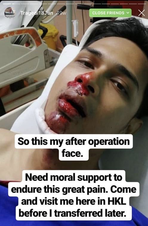 abang_naz's tweet photo. Selalu aku tengok orang patah jaw ni dalam Action Movie ja. Tak sangka, aku sendiri sekarang yang sedang lalui benda ni. Nak tahu apa rasanya patah separuh muka? Dan apa puncanya? 10 rt aku cerita. Kalau ada yang nak dengar la. Haha https://t.co/NGZbUcfbbP