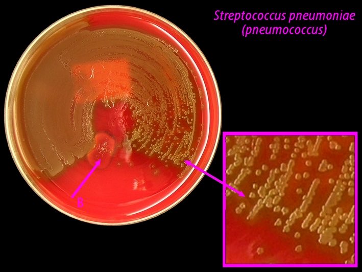  Streptococcus pneumoniae (pneumococci)• Gram-positive• Diplococci, lying end to end (glass shape)•Surrounded by a capsule, which is not visible with Gram stain• Not intracellular• Usually many in number