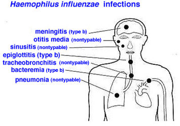 Haemophilus influenzae (especially in young children)• Gram-negative• Small bacilli (coccobacilli)•In all the above-mentioned forms of meningitis the leukocytes present are neutrophils.Listeria group.•Gram-positive bacilli