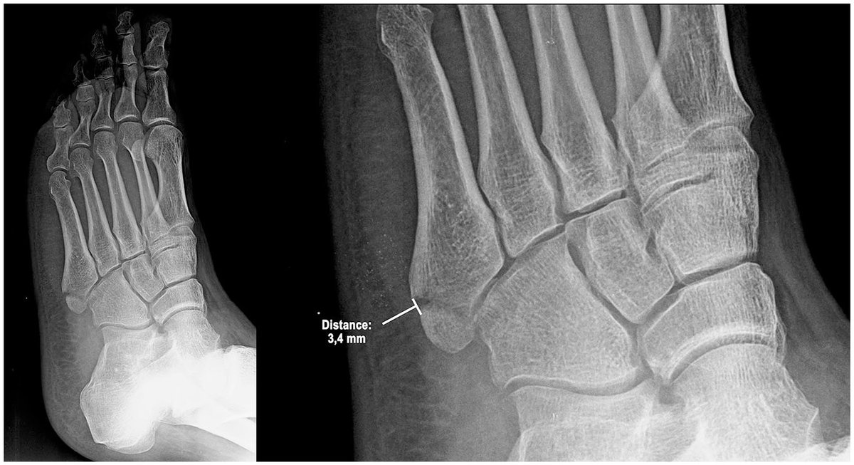 AOFAS_Journals's tweet image. The study reported better clinical and functional outcomes for proximal 5th metatarsal fractures treated with elastic bandage than with cast immobilization, regardless of degree of fracture displacement: ow.ly/SSFv50A7Yke