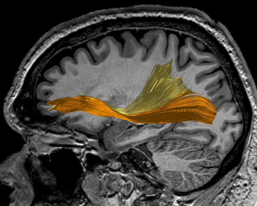 Ventral associative stream. WHAT pathway. Language role. Words -> meaning.- Direct pathway: Inferior fronto-occipital fasciculus (IFOF) - Indirect pathway:   - Uncinate (fronto-temporal)  - Inferior longitudinal fasciculus (ILF) (temporo-occipital)