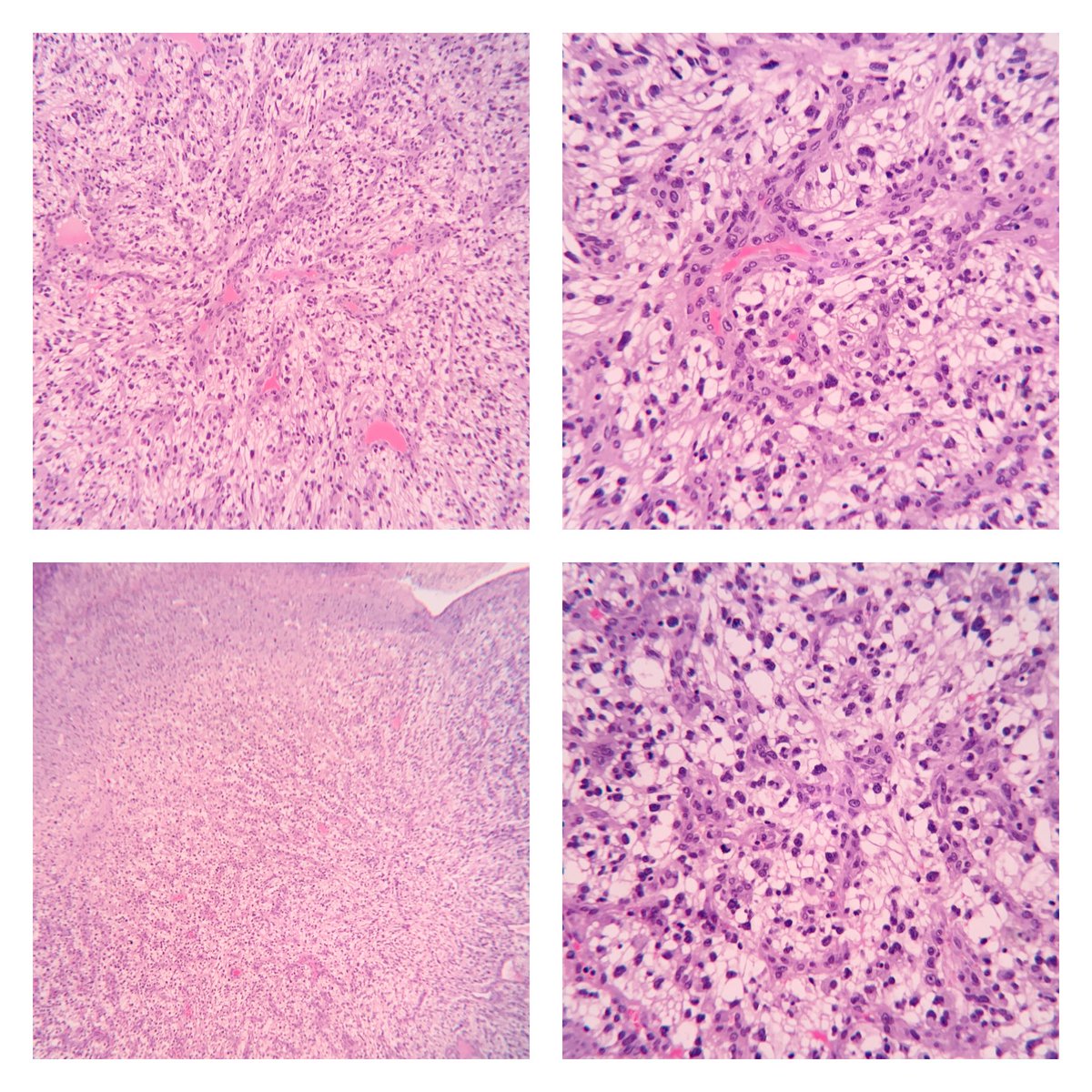 EIacovou's tweet image. Eyelid metastasis as the initial presentation of Renal cell carcinoma.
59 y/o M presented with a fast growing ulcerated nodule on the upper eyelid. Clinically chalazion or pyogenic granuloma. #twitterpath #Pathology