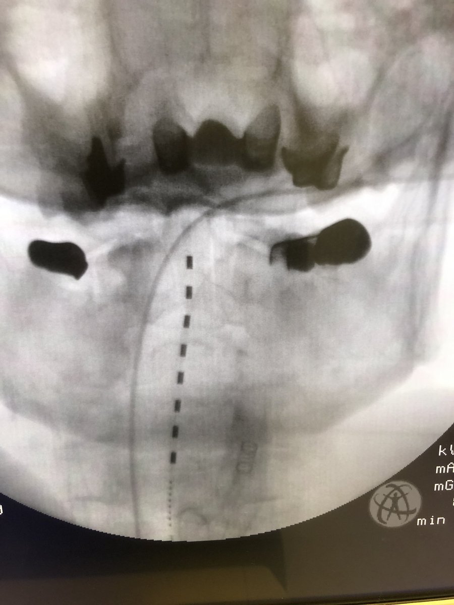 dougbeall's tweet photo. Combination procedure with right shoulder suprascapular nerve and cervical stimulator done through the same small incisions with @kienvuumd #stimwave #nobattery @SIRspecialists @ASIPP @needlejockeys @The_ASSR @ASNRehab https://t.co/DQmsemNGlI