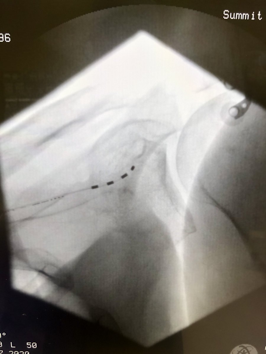 dougbeall's tweet photo. Combination procedure with right shoulder suprascapular nerve and cervical stimulator done through the same small incisions with @kienvuumd #stimwave #nobattery @SIRspecialists @ASIPP @needlejockeys @The_ASSR @ASNRehab https://t.co/DQmsemNGlI