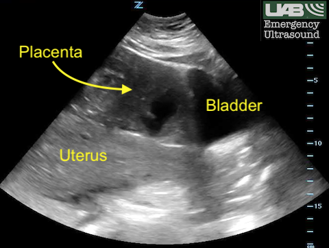 UAB Emergency Ultrasound tweet media