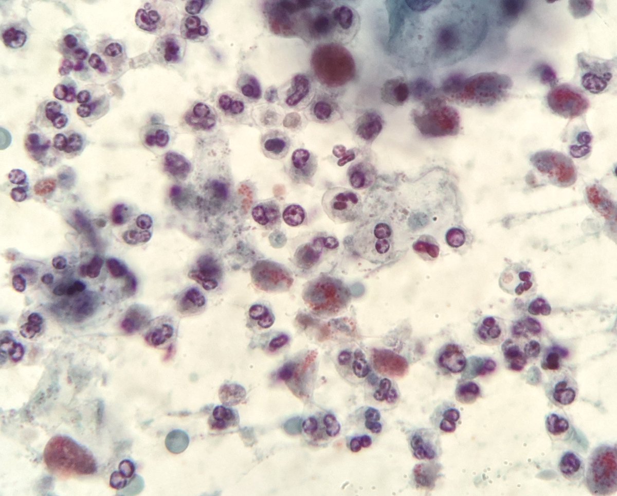 PSzwebel's tweet photo. Nice trichomonas
#cytology, #pathology, #gynpath, #cytop https://t.co/WyiMzFSn4R