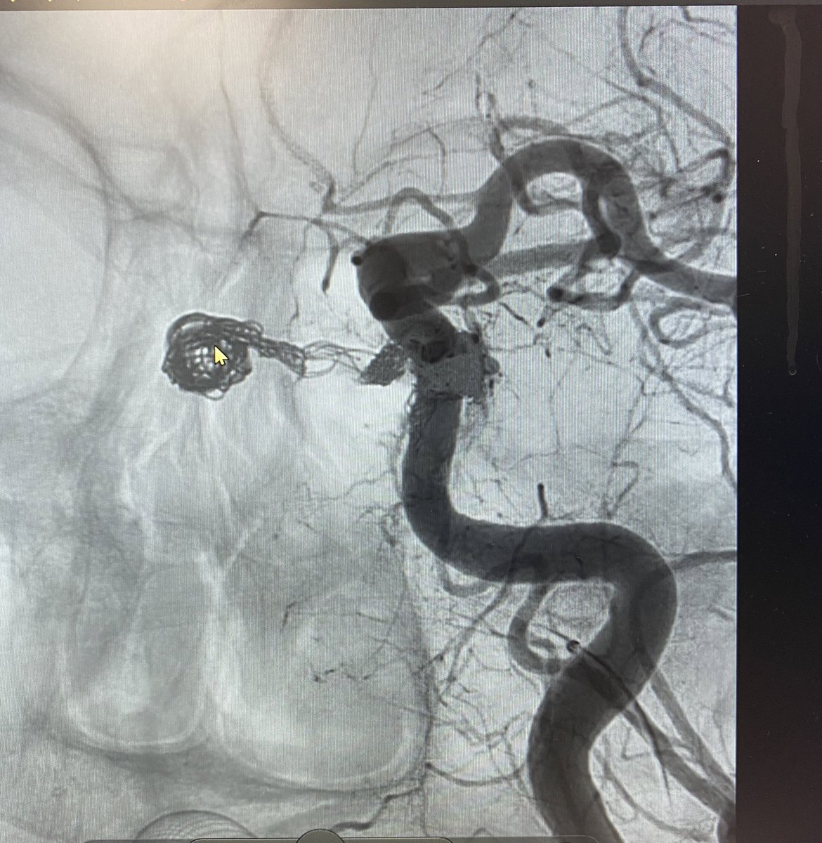 Claudio Rodríguez Fernández (@dr_crdguez) on Twitter photo 👀 Bilateral CSdAVF is very rare, only a few cases have been reported. Transvenous approach↖️IPS. <a href="/HUInfantaElena/">Hosp. Infanta Elena</a> <a href="/Hospital_FJD/">Fundación Jiménez Díaz</a> <a href="/jaimefercu/">Jaime FC</a> <a href="/fernandoybacar/">Fernando Ybáñez Carr</a> <a href="/AnaNeurorx/">Ana Alonso NeuroRx</a> <a href="/neuroangio1/">Neuroangio</a> <a href="/JNIS_BMJ/">JNIS</a> <a href="/AANSNeurosurg/">AANS Neurosurgeon</a> <a href="/TheASNR/">The American Society of Neuroradiology</a> <a href="/BaltSpain/">Balt Spain Medical</a> <a href="/neurosurgery/">Neurosurgery</a> <a href="/Dr_CRdguez/">Claudio Rodríguez Fernández</a> 👀 Bilateral CSdAVF is very rare, only a few cases have been reported. Transvenous approach↖️IPS. <a href="/HUInfantaElena/">Hosp. Infanta Elena</a> <a href="/Hospital_FJD/">Fundación Jiménez Díaz</a> <a href="/jaimefercu/">Jaime FC</a> <a href="/fernandoybacar/">Fernando Ybáñez Carr</a> <a href="/AnaNeurorx/">Ana Alonso NeuroRx</a> <a href="/neuroangio1/">Neuroangio</a> <a href="/JNIS_BMJ/">JNIS</a> <a href="/AANSNeurosurg/">AANS Neurosurgeon</a> <a href="/TheASNR/">The American Society of Neuroradiology</a> <a href="/BaltSpain/">Balt Spain Medical</a> <a href="/neurosurgery/">Neurosurgery</a> <a href="/Dr_CRdguez/">Claudio Rodríguez Fernández</a>