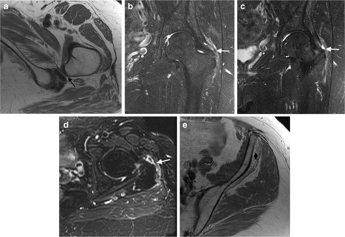 BredellaMD's tweet photo. Check out our new article on the role of hip abductor pathology in ischiofemoral impingement 
@SkeletalRadiol
 https://t.co/ZQ2dHInkDW https://t.co/G0G7bnzw8L