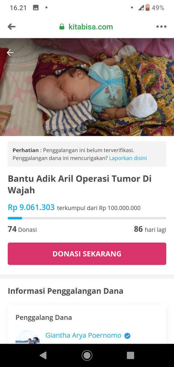 Masih ada 86 hari lagi membantu adik aril untuk operasi tumor diwajah terima kasih orang baik...
