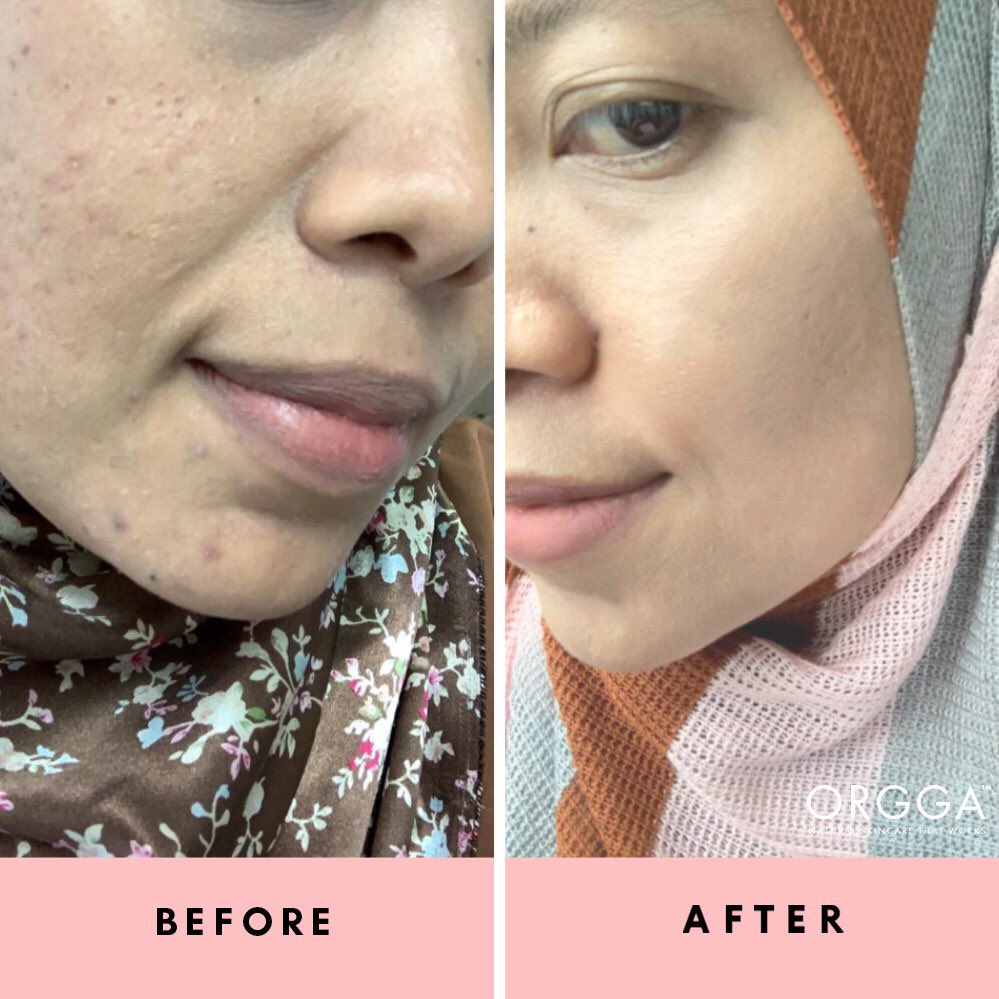 OrggaMalaysia's tweet photo. #OrggaFeedback | Honest review by Norsafrina from Penang, after using our Oliva Set [suitable for dry &amp; mature skin type] for 5 months , her skin getting better with Orgga Malaysia and FREE consultation from our Orgga Rangers @asyida_ ❤️ https://t.co/CBT3hg0uoo