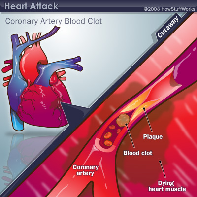 "Apa yg terjadi jika pembuluh koroner tersumbat?"Yap! serangan jantung!Pada beberapa kasus, gangguan pada sistem kardiovaskuler dapat memicu sudden cardiac arrest, atau henti jantung mendadak. Jika tidak tertolong, orang bs meninggal mendadak