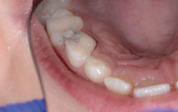 Make sure you read this overview of the current clinical techniques relating to silver diamine fluoride: go.nature.com/3hIzPLs